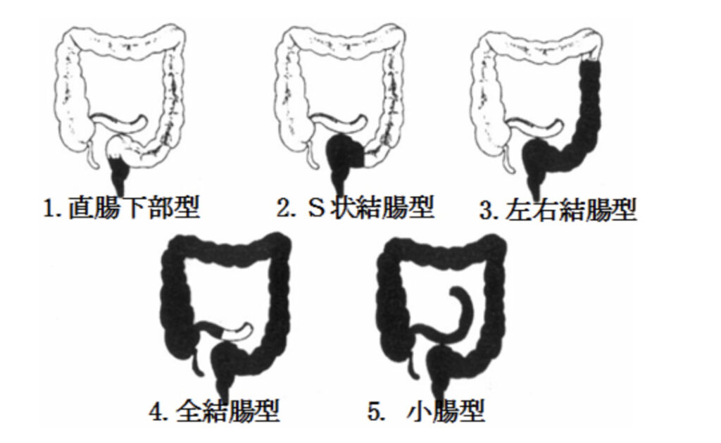 ヒルシュスプルング病